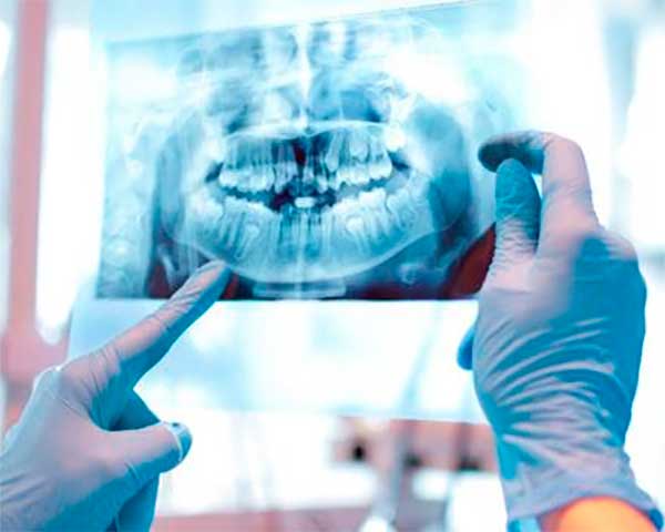 Cirugía oral en Clínica Dental Vallecas