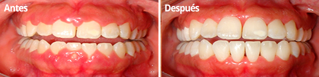 Tratamiento de la gingivectomía con láser en Clínica Dental Vallecas