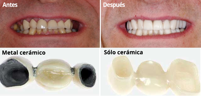 Rejuvenecimiento dental en Clínica Dental Vallecas