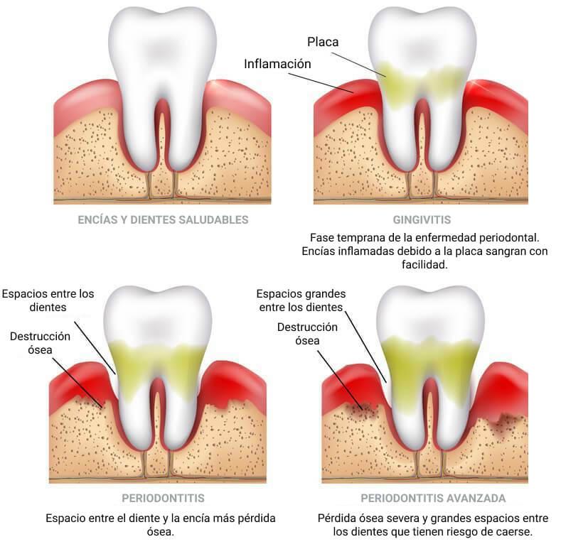 Tratamiento de enfermedades periodentales en Clínica Dental Vallecas