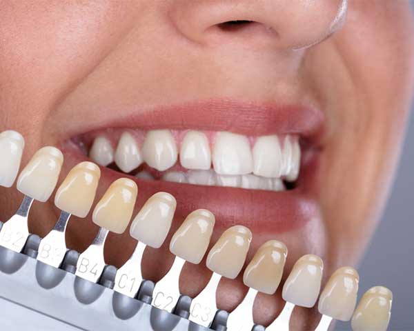 Estética y cosmética dental en Clínica Dental Vallecas