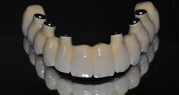 Implante prótesis fija - Porcelana en Clínica Dental Vallecas