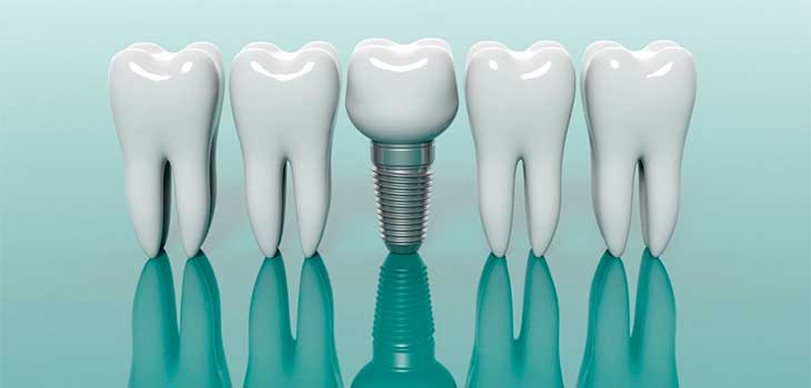 Promo: Implante + Corona en Clínica Dental Vallecas