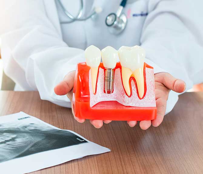 Solicita información detallada sobre tu implante en Clínica Dental Vallecas