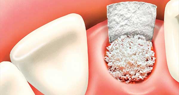 Implantes sin hueso en Clínica Dental Vallecas