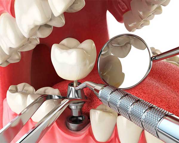 Implantología avanzada en Clínica Dental Vallecas