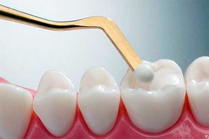 Empastes dentales en Clínica Dental Vallecas