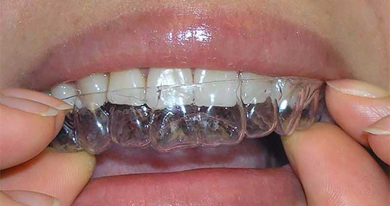 Ortodoncia invisible (invisaling) en Clínica Dental Vallecas
