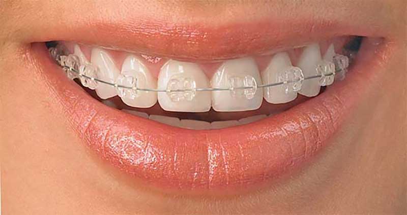 Brakets estéticos de zafiro en Clínica Dental Vallecas