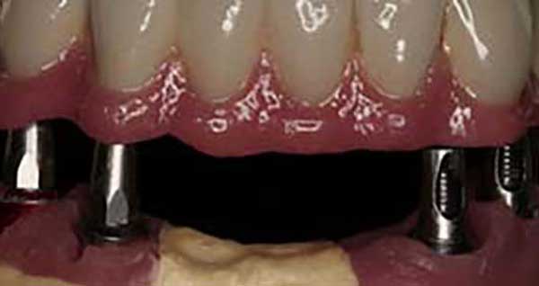 Puentes sobre implantes en Clínica Dental Vallecas