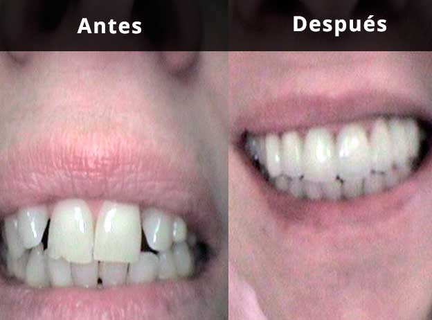 Comparativa. Rehabilitación con coronas de circonio en Clínica Dental Vallecas