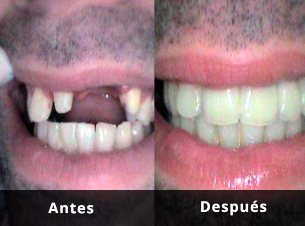 Comparativa: Solución estética ante la falta de piezas en Clínica Dental Vallecas