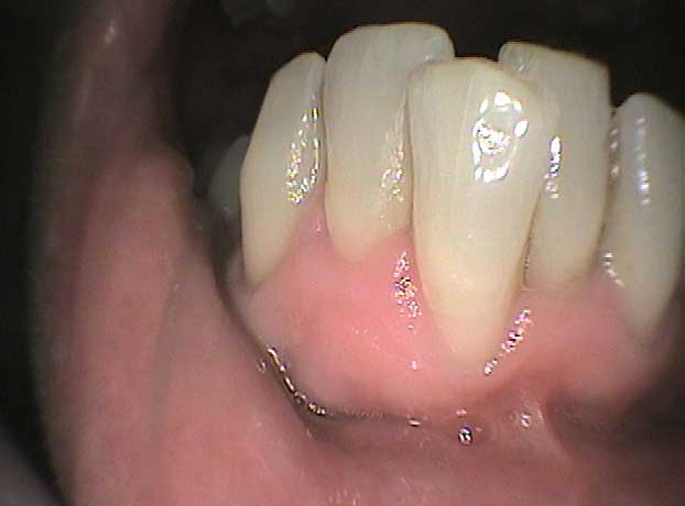 Rehabilitación arcada superior e inferior con coronas de circonio en Clínica Dental Vallecas (antes - 1)