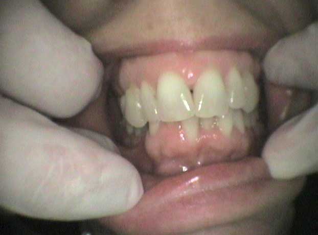 Rehabilitación arcada superior e inferior con coronas de circonio en Clínica Dental Vallecas (antes - 2)