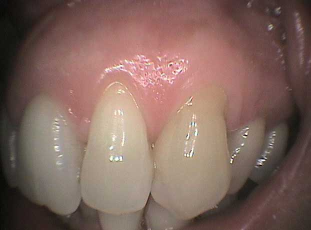 Rehabilitación arcada superior e inferior con coronas de circonio en Clínica Dental Vallecas (antes - 4)