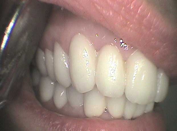 Rehabilitación arcada superior e inferior con coronas de circonio en Clínica Dental Vallecas (después - 3)