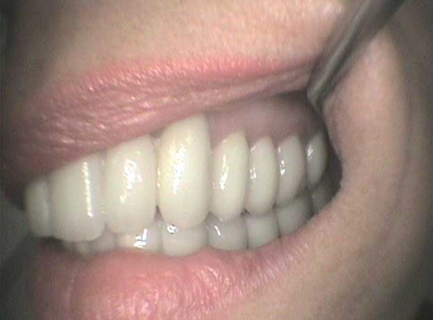 Rehabilitación arcada superior e inferior con coronas de circonio en Clínica Dental Vallecas (después - 4)
