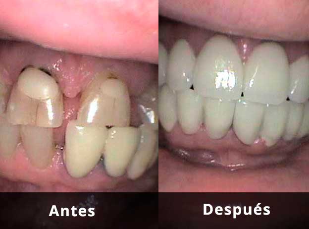 Tres espectaculares casos clínicos de reconstrucción con coronas en Clínica Dental Vallecas