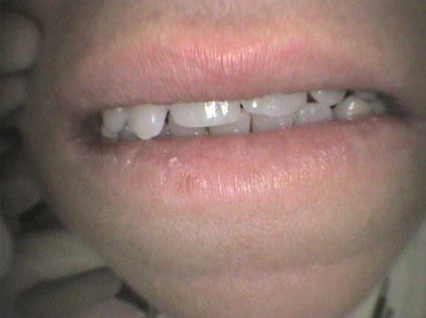 Rehabilitación con coronas de circonio en Clínica Dental Vallecas (antes - 1)