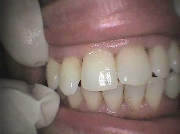 Rehabilitación con coronas de circonio en Clínica Dental Vallecas (antes - 2)