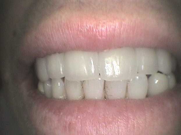 Rehabilitación con coronas de circonio en Clínica Dental Vallecas (después - 1)