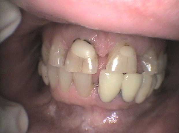 Rehabilitación en porcelana en Clínica Dental Vallecas (antes - 1)