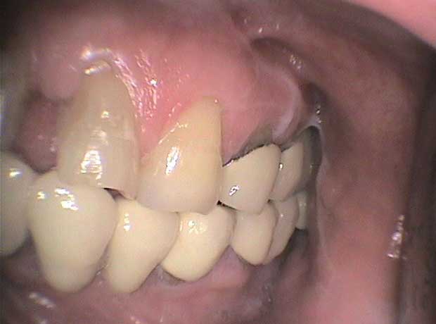Rehabilitación en porcelana en Clínica Dental Vallecas (antes - 3)