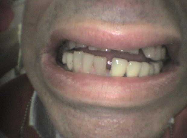 Rehabilitación en porcelana en Clínica Dental Vallecas (antes - 4)