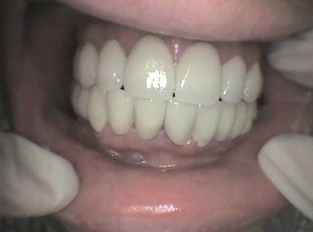 Rehabilitación en porcelana en Clínica Dental Vallecas (después - 1)