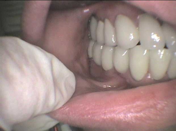 Rehabilitación en porcelana en Clínica Dental Vallecas (después - 2)