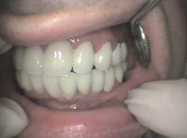 Rehabilitación en porcelana en Clínica Dental Vallecas (después - 3)
