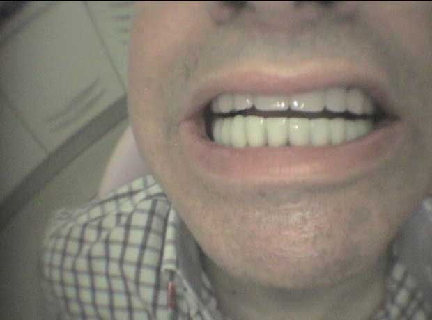 Rehabilitación en porcelana en Clínica Dental Vallecas (después - 4)