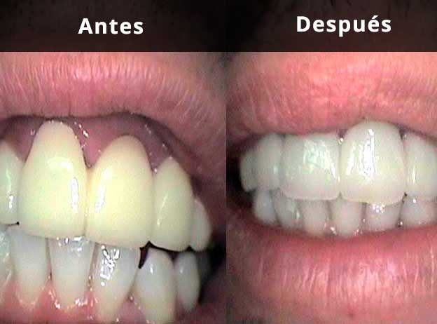 Comparativa: Estética dental con coronas de circonio en Clínica Dental Vallecas 