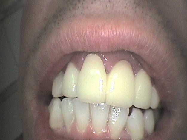 Estética con coronas de circonio en Clínica Dental Vallecas (antes - 1)
