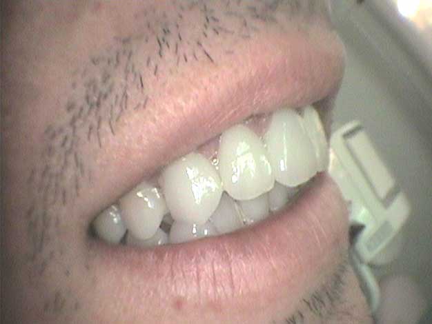 Estética con coronas de circonio en Clínica Dental Vallecas (después - 3)