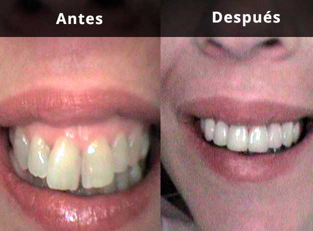 Comparativa: Estética dental con coronas de circonio en Clínica Dental Vallecas