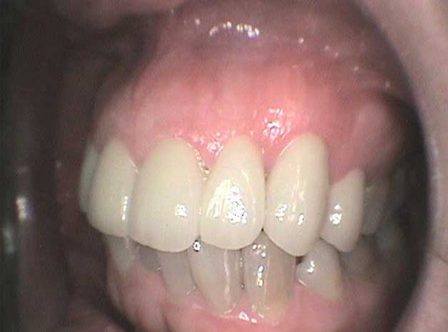Estética con coronas de circonio en Clínica Dental Vallecas (después - 2)