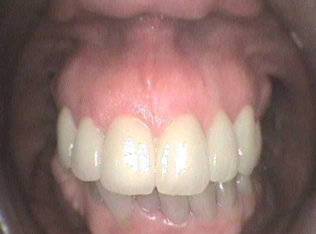 Estética con coronas de circonio en Clínica Dental Vallecas (después - 3)