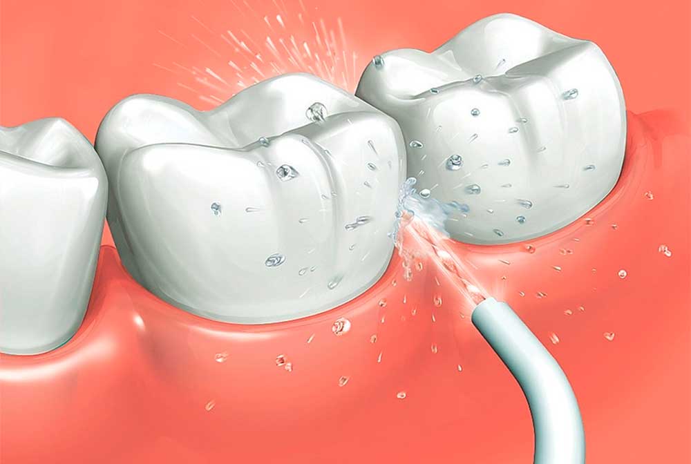 Clínica Dental Vallecas te ayuda a elegir el irrigador dental más adecuado para ti