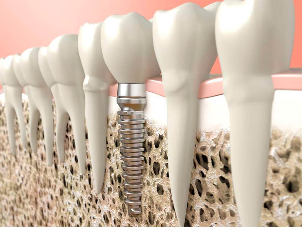 Clínica Dental Vallecas responde a las preguntas más frecuentes sobre implantes dentales
