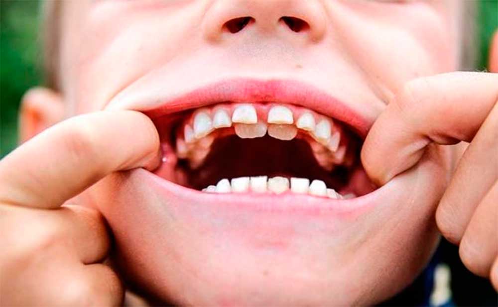 Los dientes de tiburón en niños: una anomalía no grave pero que requiere la atención del odonpediatra
