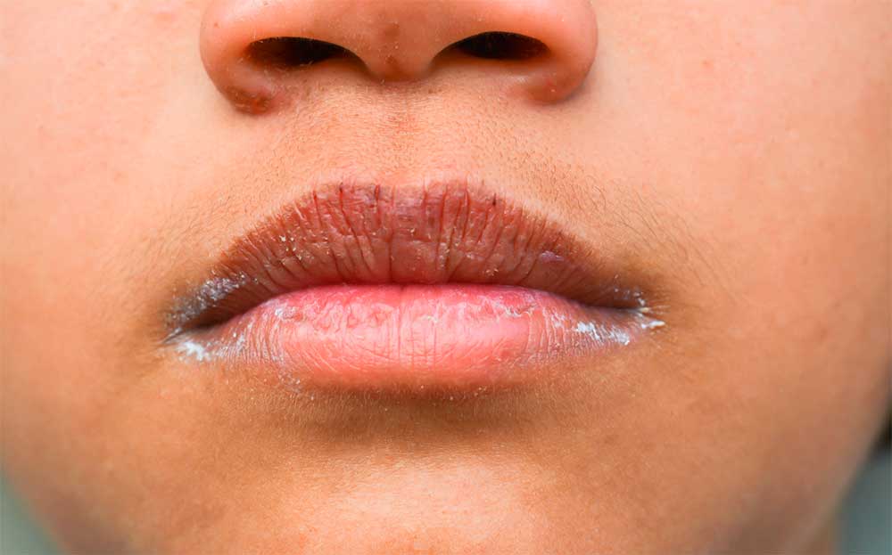 Xerostomia o el síndrome de la boca seca: causas y tratamientos