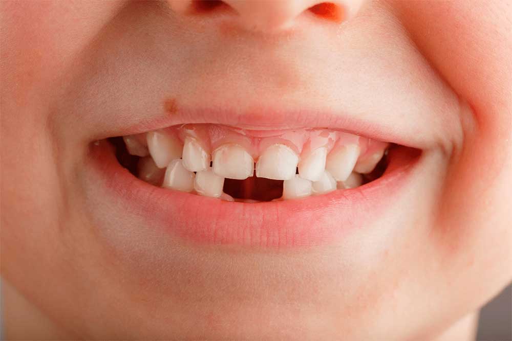 La agenesia dental: ausencia congénita de uno o más dientes