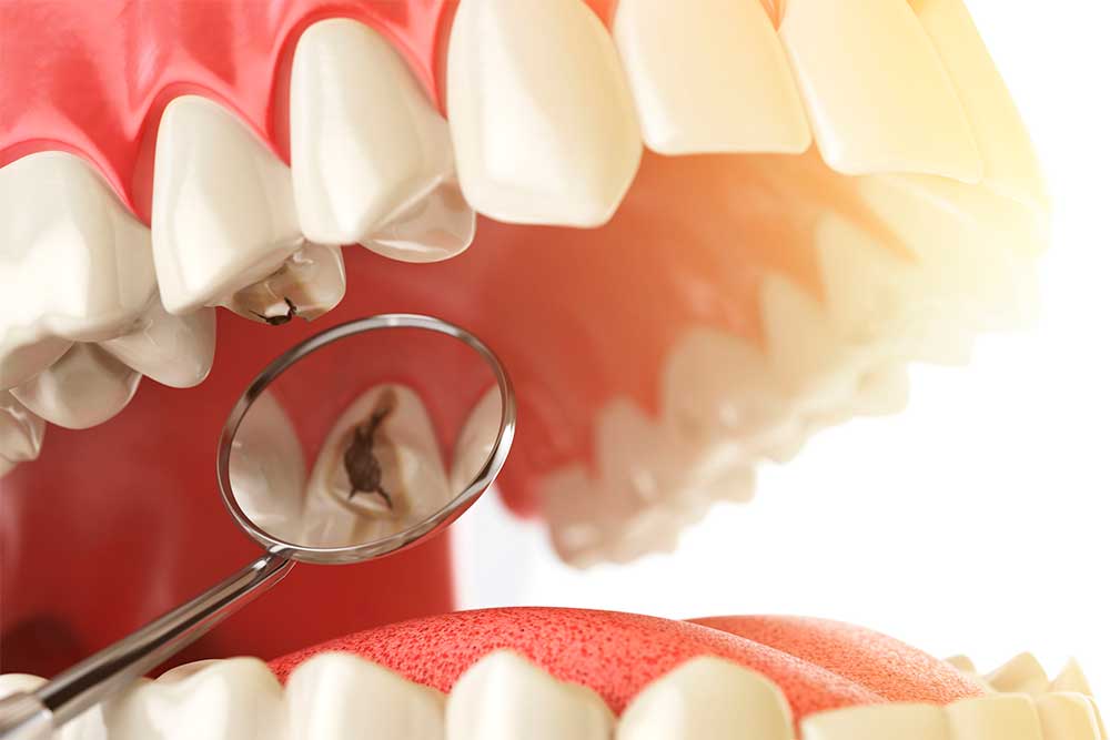Cavitación dental y cavidad dental. Aclarando términos. Clínica Dental Vallecas