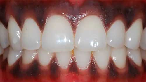 Melanosis gingival: tratamientos para las encías negras. Clínica Dental Vallecas