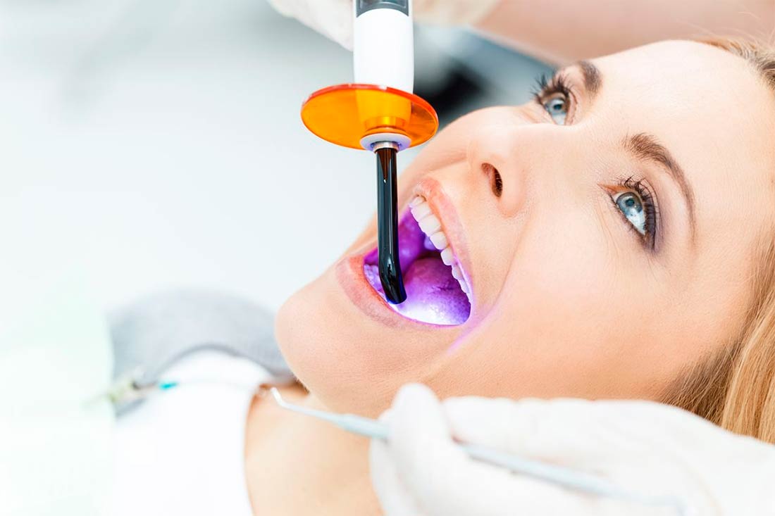 auxiliar Corte considerado Diferentes técnicas de blanqueamiento dental en Clínica Dental Vallecas