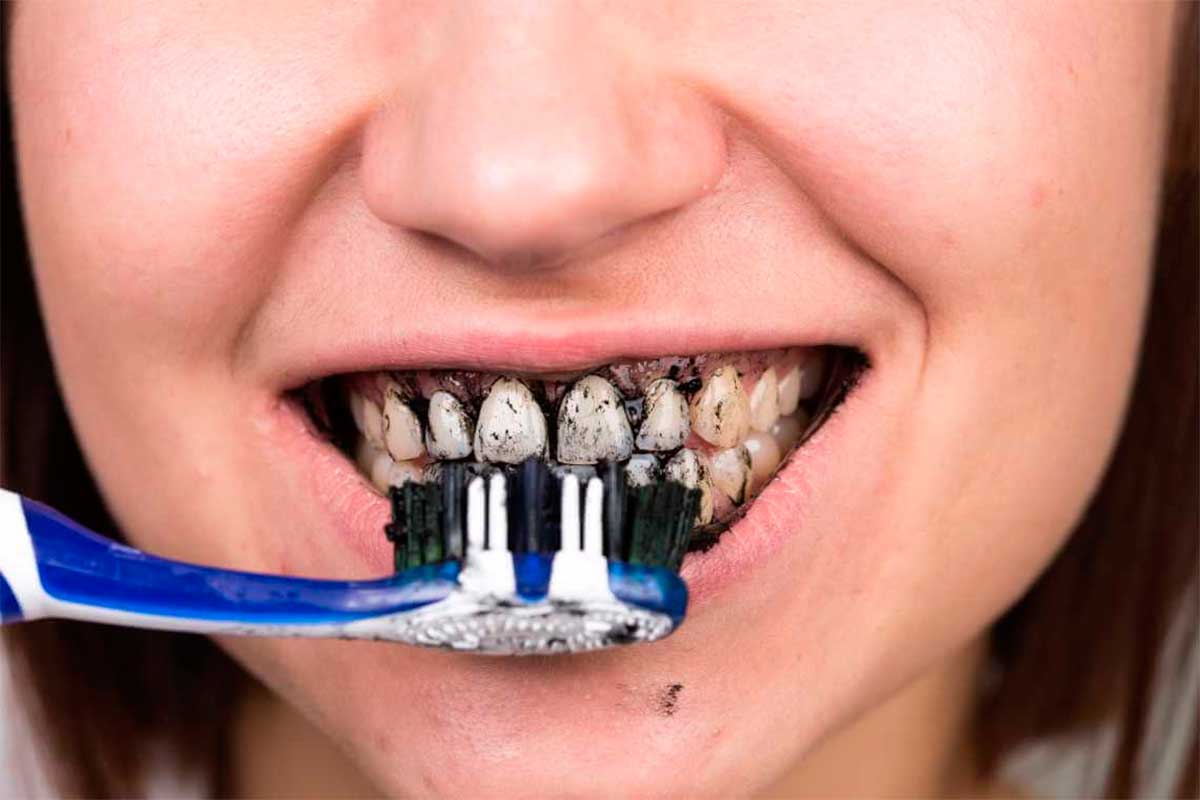 Peligros del carbón activado como blanqueador dental. Clínica Dental Vallecas