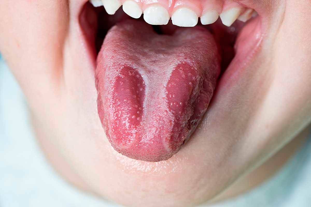 Lengua geográfica: qué es, síntomas, cómo tratarla. Clínica Dental Vallecas