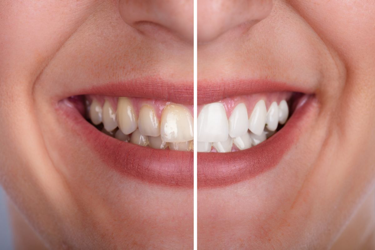 blanqueamiento dental Madrid