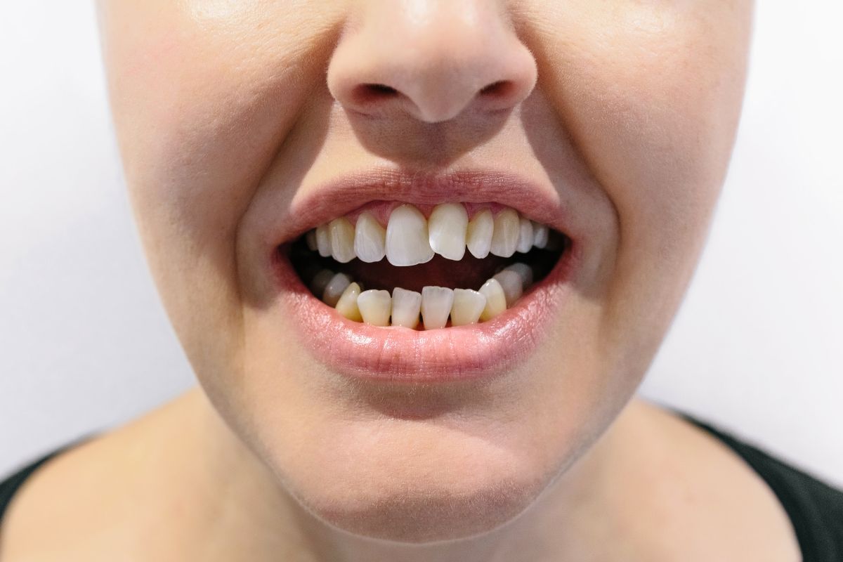 malformaciones dentales